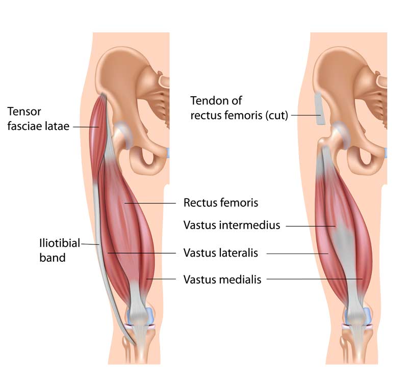 Managing your Medial Knee Pain: MCL injuries