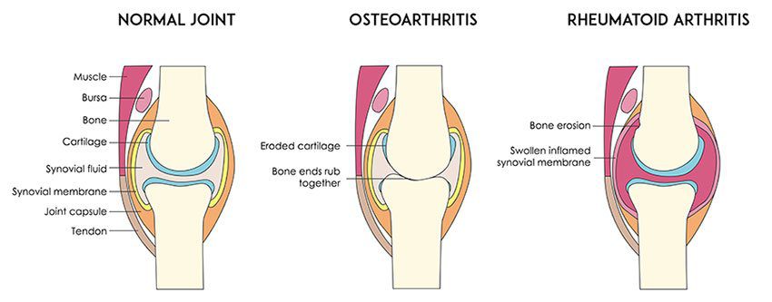 Managing your Medial Knee Pain: MCL injuries