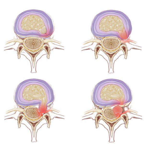 disc-bulge-physio-fusion