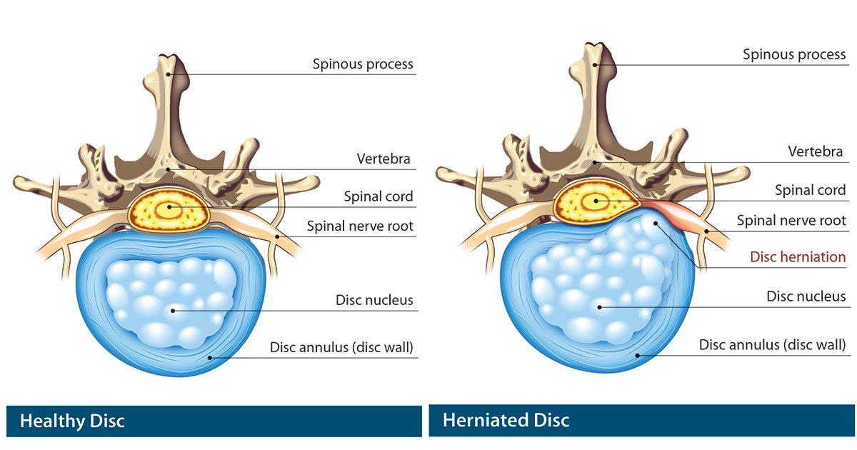 herniated-healthy-disc | Physio Fusion